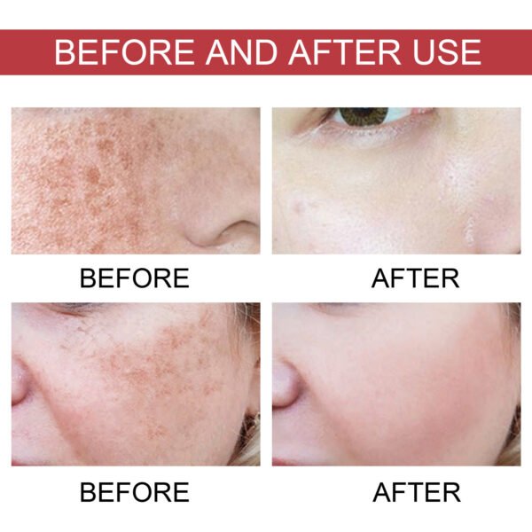 Hoygi Black Spot Repair Essence Lighten Skin Black Spot And Age Spot Moisturizing&Brightening Repair Essence - Image 4