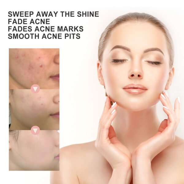 OUHOE Acne Patch Repair Acne Acne Redness Pore Cleansing & Moisturizing Patch - Image 3